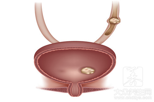 怎么会得膀胱炎
