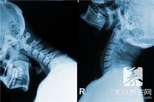 颈椎钙化是怎么引起的