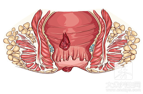 屁眼发红疼痛怎么办