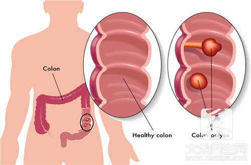 肠炎和肠癌的症状区别