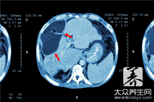 cin2级可以完全治愈吗