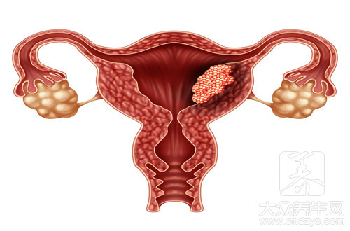 宫劲癌三大主要症状