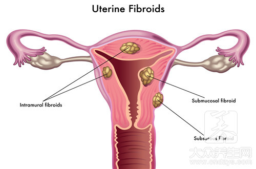 医生提醒，中老年子宫肌瘤，多是3种原因，注意4种不良饮食习惯