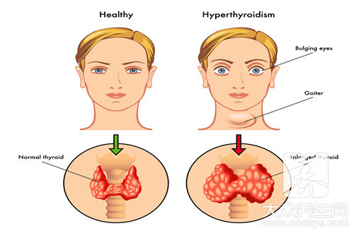 甲亢眼皮肿小妙招