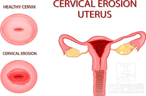 hpv56阳性宫颈癌的几率