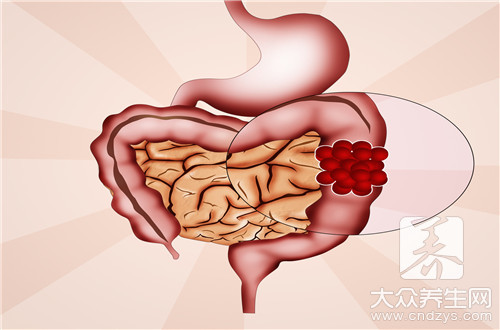 肠癌左边还是右边腹痛