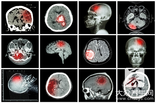 脑冲血能治好吗