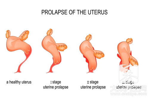 子宫下垂怎么治疗