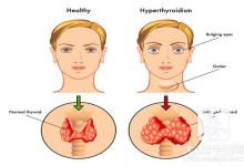 甲亢眼皮肿会一辈子吗
