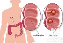肠炎和肠癌的症状区别