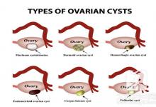 宫颈囊肿怎么办