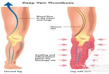 深度静脉血栓的症状