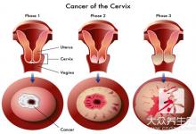 宫颈糜烂会癌变吗