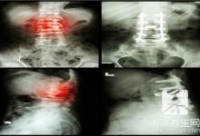 脊椎第四五节疼痛