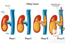 肾病是“拖”出来的 4种现象肾脏恐已透支