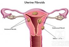 身体有这4个症状，说明你长子宫肌瘤了