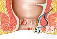 为什么你成了有“痔”之士？3招远离“十人九痔”，早知少遭罪
