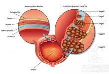 膀胱癌晚期 生不如死