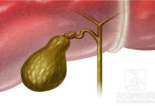 胆囊堵塞原因引起的