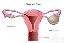 附件囊肿危险吗