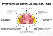 怎么区分外痔和内痔