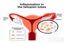 盆腔炎患者有哪些饮食需要注意，这几种，值得收藏！