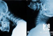 颈椎半脱位症状