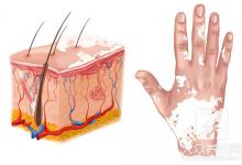 白斑病能治得好吗