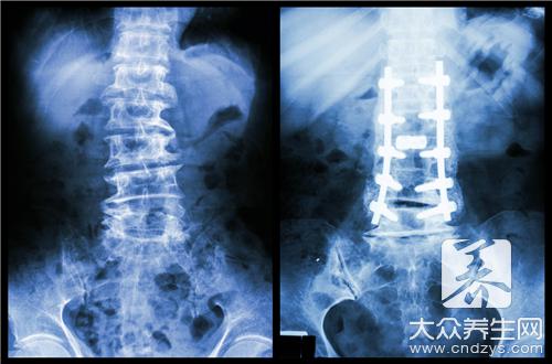 强直性脊柱炎打生物制剂有哪些注意事项?