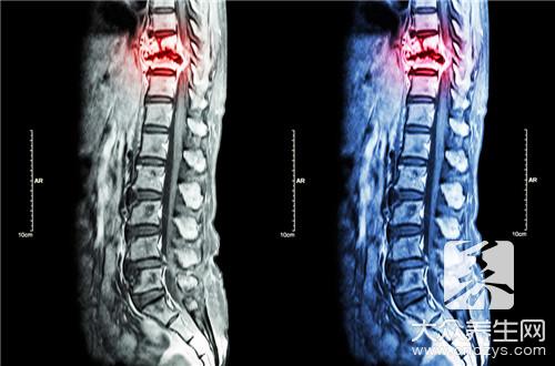 脊椎空洞怎么回事呢？