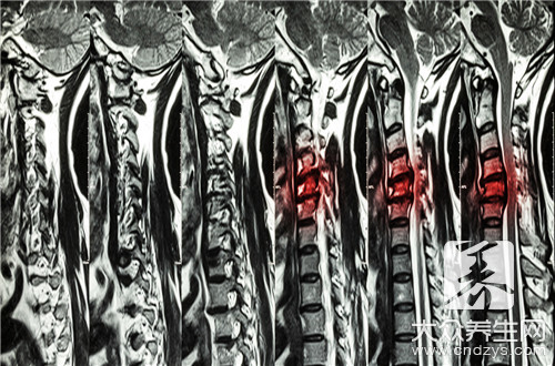 颈椎病会导致脑梗吗