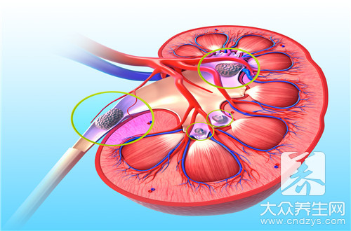 肾结晶是什么病